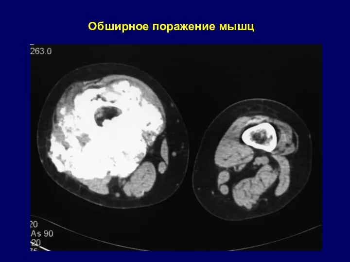 Обширное поражение мышц