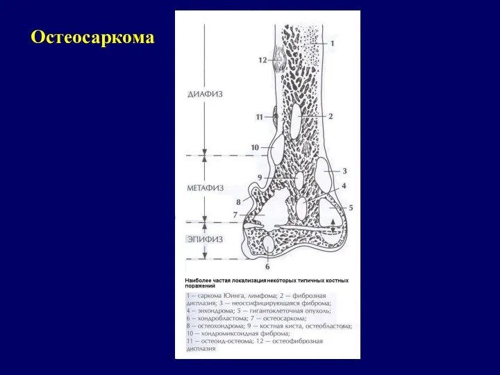 Остеосаркома