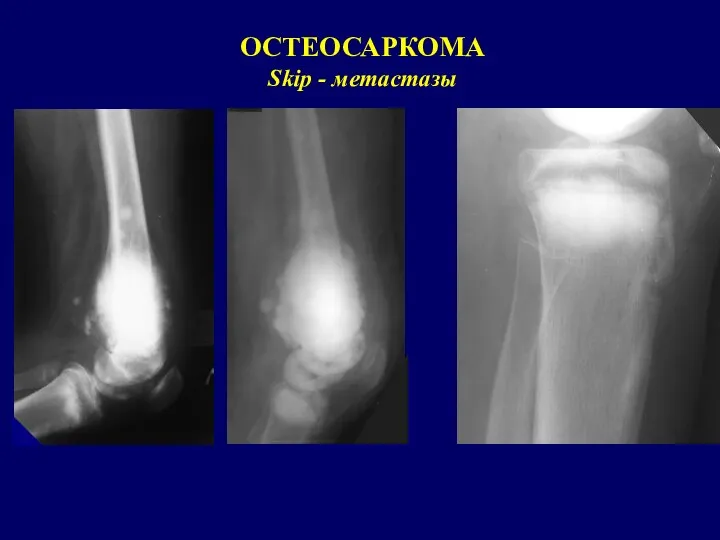 ОСТЕОСАРКОМА Skip - метастазы