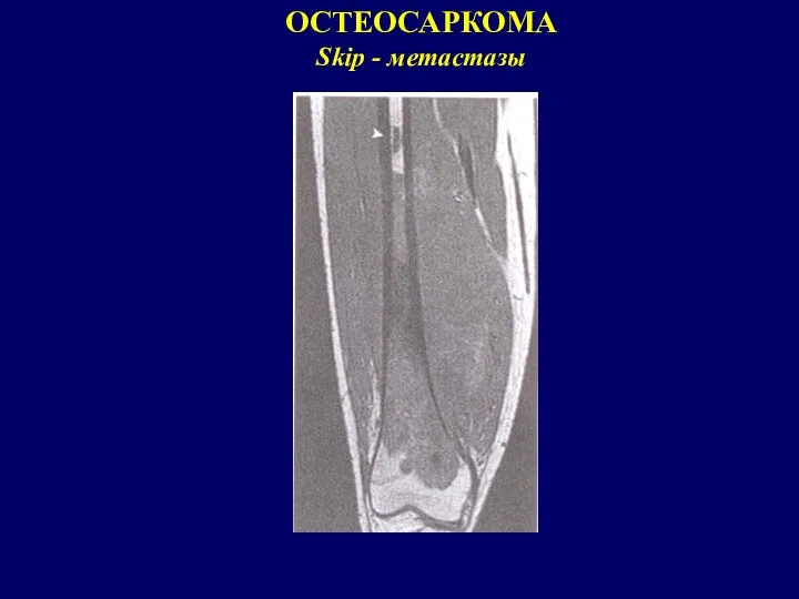 ОСТЕОСАРКОМА Skip - метастазы