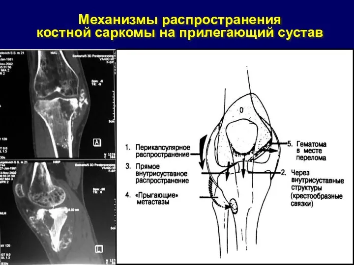 Механизмы распространения костной саркомы на прилегающий сустав