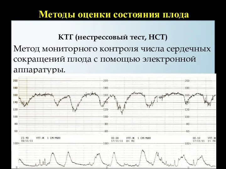 Методы оценки состояния плода КТГ (нестрессовый тест, НСТ) Метод мониторного контроля