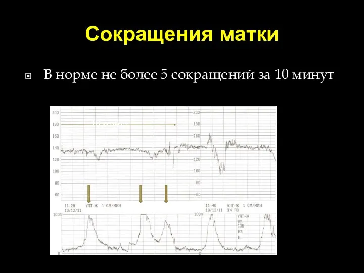 Сокращения матки В норме не более 5 сокращений за 10 минут 10 минут