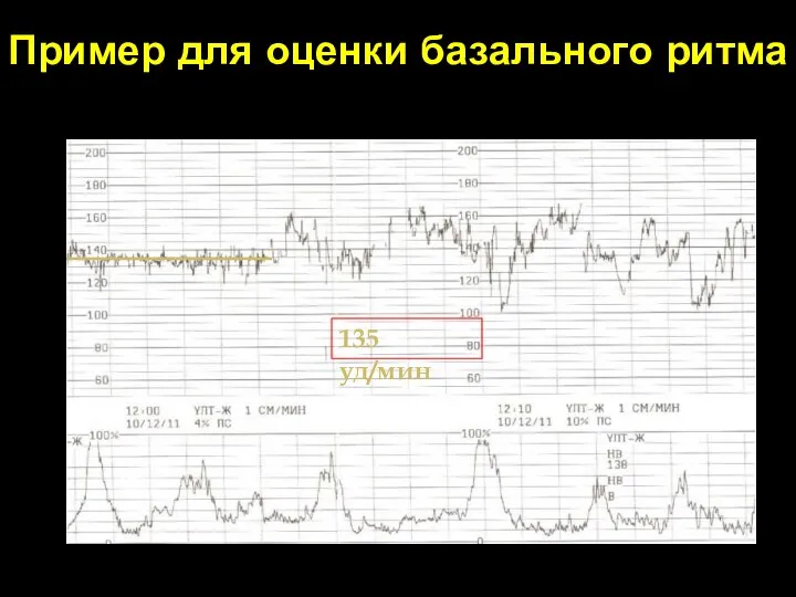 Пример для оценки базального ритма 135 уд/мин