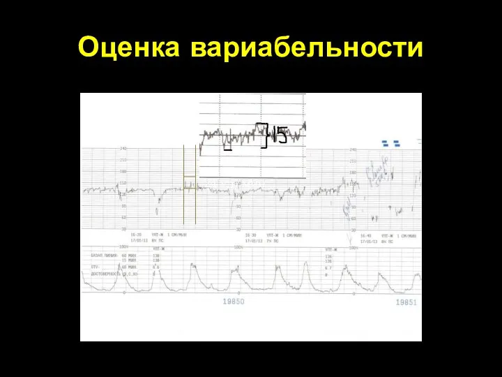 Оценка вариабельности 24 уд/мин 1 мин