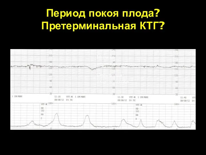 Период покоя плода? Претерминальная КТГ? Низкая вариабильность Отсутствие акцелерации