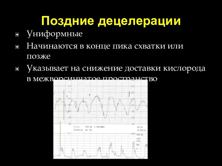 Поздние децелерации Униформные Начинаются в конце пика схватки или позже Указывает