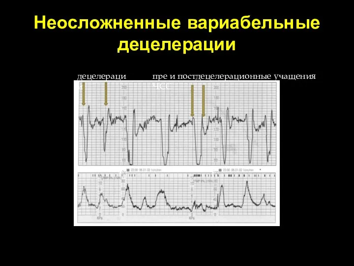 Неосложненные вариабельные децелерации децелерации пре и постдецелерационные учащения ЧСС