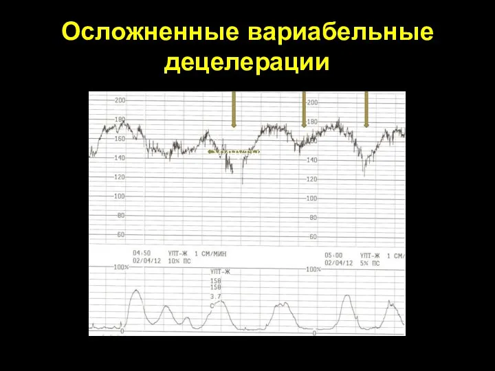 Осложненные вариабельные децелерации 3 минуты