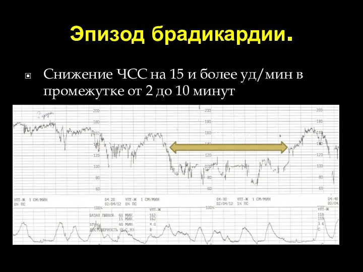 Эпизод брадикардии. Снижение ЧСС на 15 и более уд/мин в промежутке