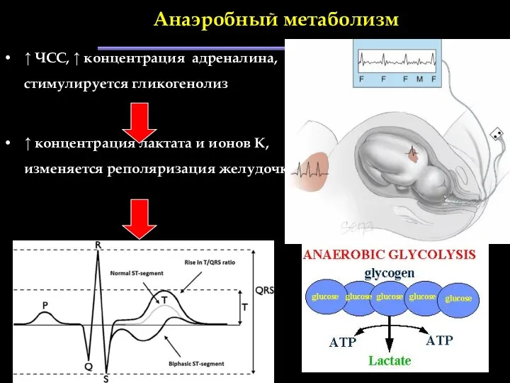 Анаэробный метаболизм ↑ ЧСС, ↑ концентрация адреналина, стимулируется гликогенолиз ↑ концентрация