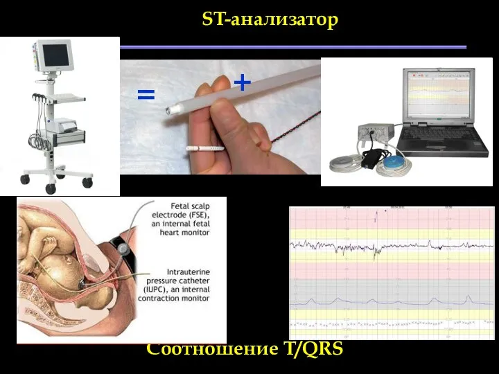 ST-анализатор = + Соотношение T/QRS