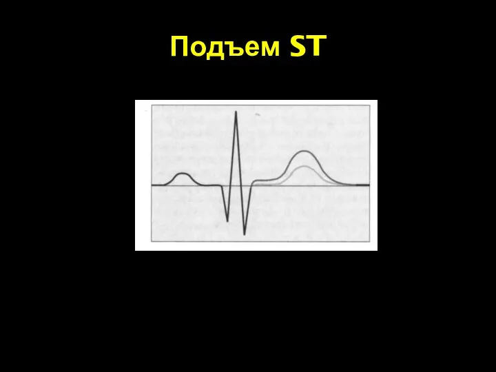 Подъем ST