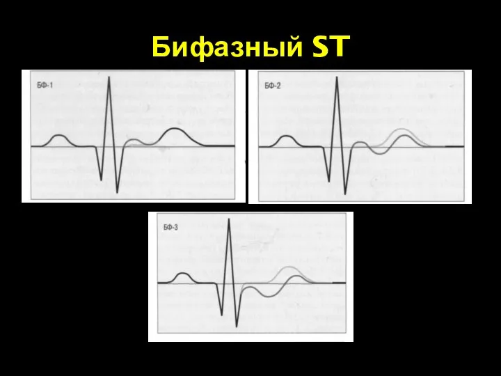 Бифазный ST