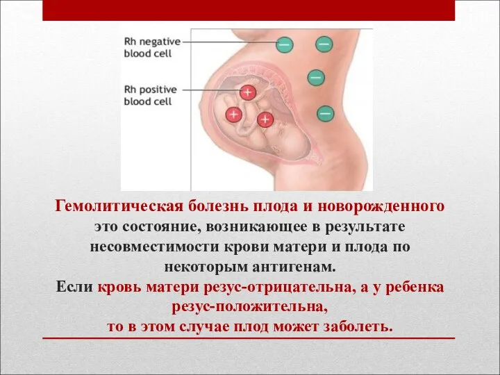 Гемолитическая болезнь плода и новорожденного это состояние, возникающее в результате несовместимости