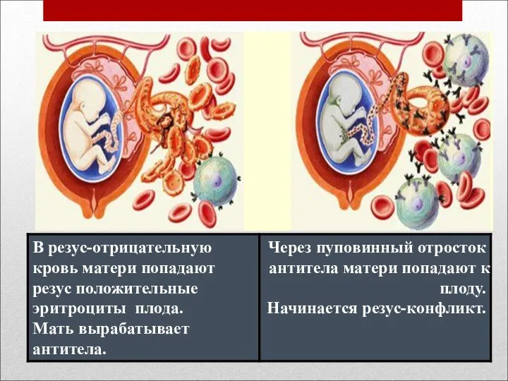 Резус – конфликт матери и плода