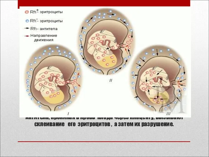 Резус – конфликт матери и плода. Антитела, проникая в кровь плода