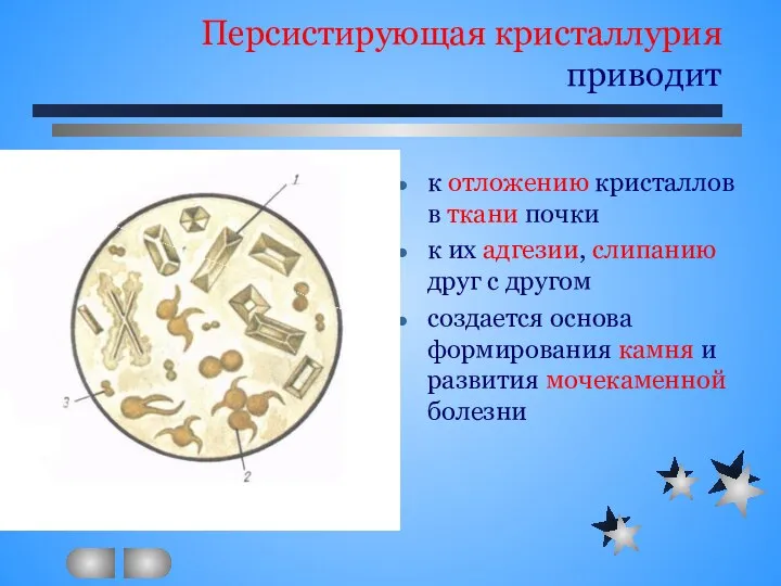 Персистирующая кристаллурия приводит к отложению кристаллов в ткани почки к их