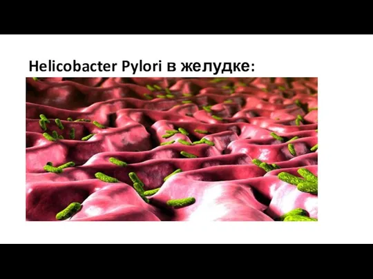 Helicobacter Pylori в желудке: