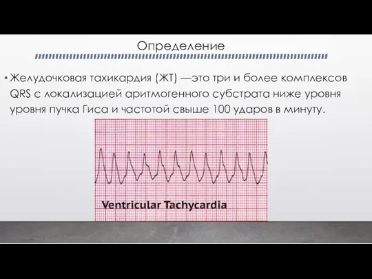 Определение Желудочковая тахикардия (ЖТ) —это три и более комплексов QRS с