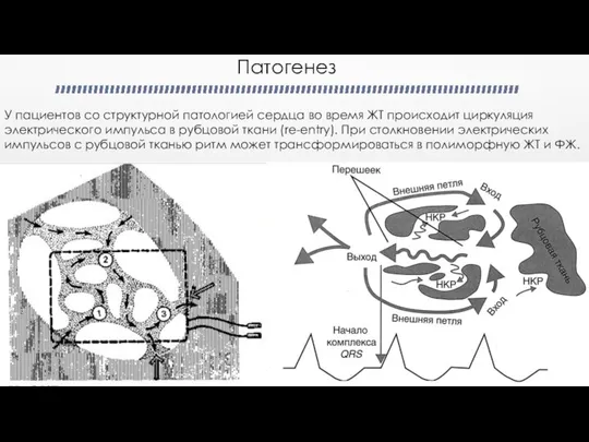 Патогенез У пациентов со структурной патологией сердца во время ЖТ происходит