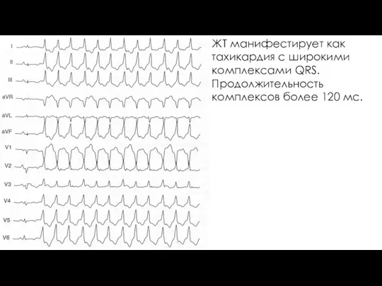 ЖТ манифестирует как тахикардия с широкими комплексами QRS. Продолжительность комплексов более 120 мс.