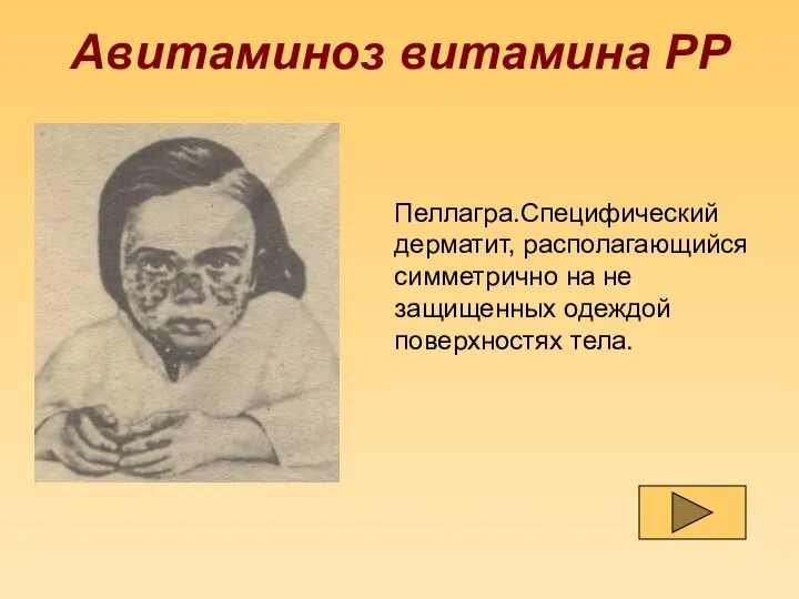 Авитаминоз витамина РР Пеллагра.Специфический дерматит, располагающийся симметрично на не защищенных одеждой поверхностях тела.