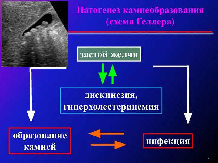 Патогенез камнеобразования (схема Геллера) застой желчи дискинезия, гиперхолестеринемия образование камней инфекция