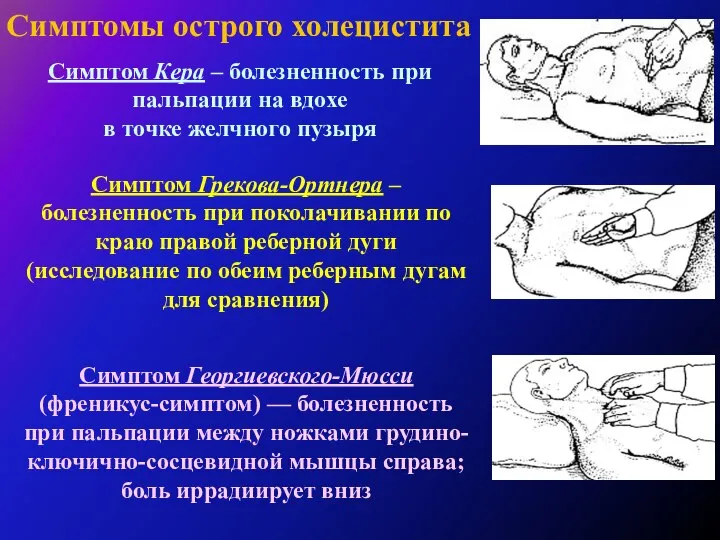 Симптомы острого холецистита Симптом Кера – болезненность при пальпации на вдохе