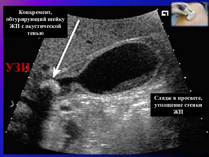 УЗИ Конкремент, обтурирующий шейку ЖП с акустической тенью Сладж в просвете, утолщение стенки ЖП