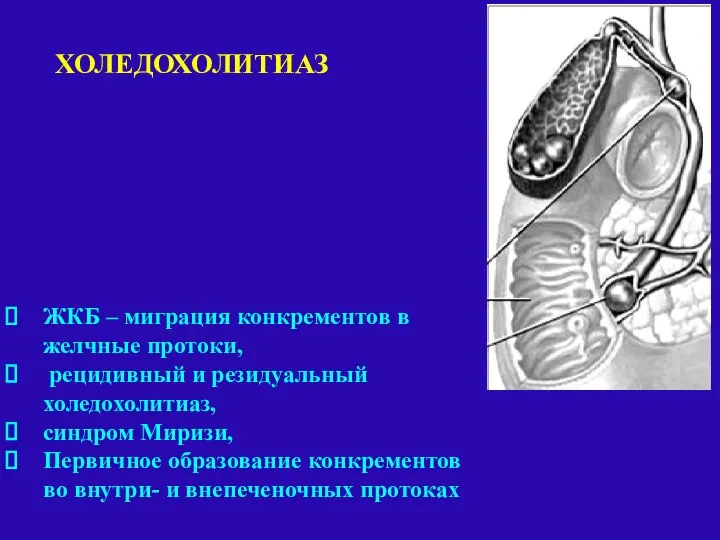 ЖКБ – миграция конкрементов в желчные протоки, рецидивный и резидуальный холедохолитиаз,