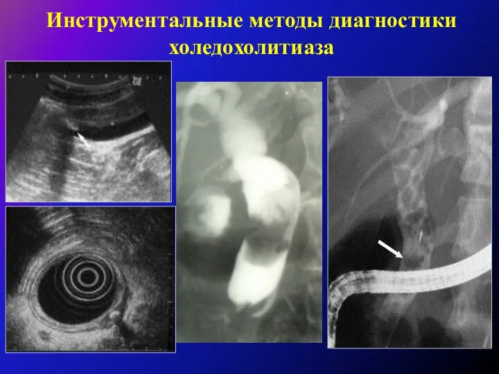 Инструментальные методы диагностики холедохолитиаза