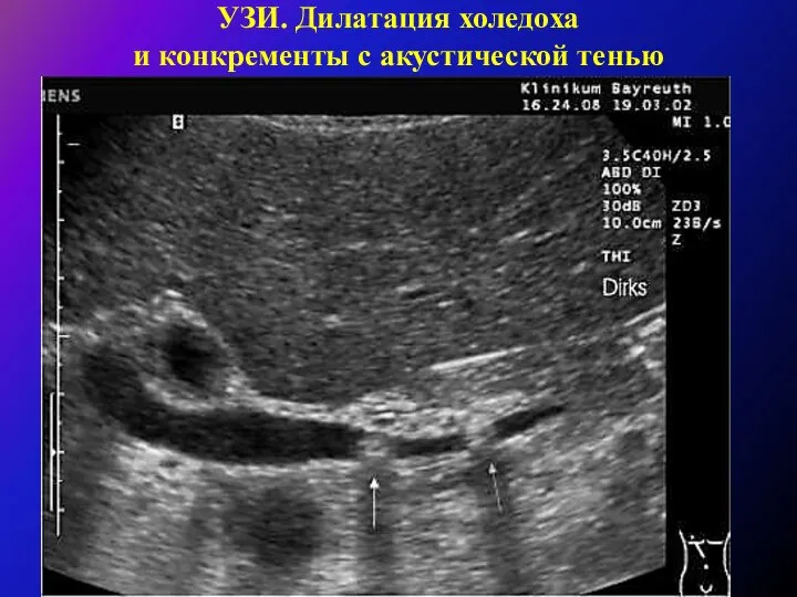 УЗИ. Дилатация холедоха и конкременты с акустической тенью