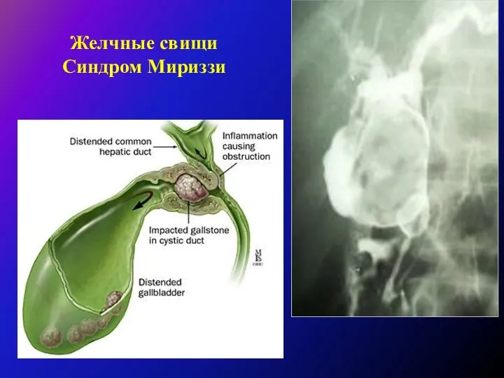 Желчные свищи Синдром Мириззи