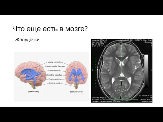 Что еще есть в мозге? Желудочки