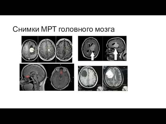 Снимки МРТ головного мозга