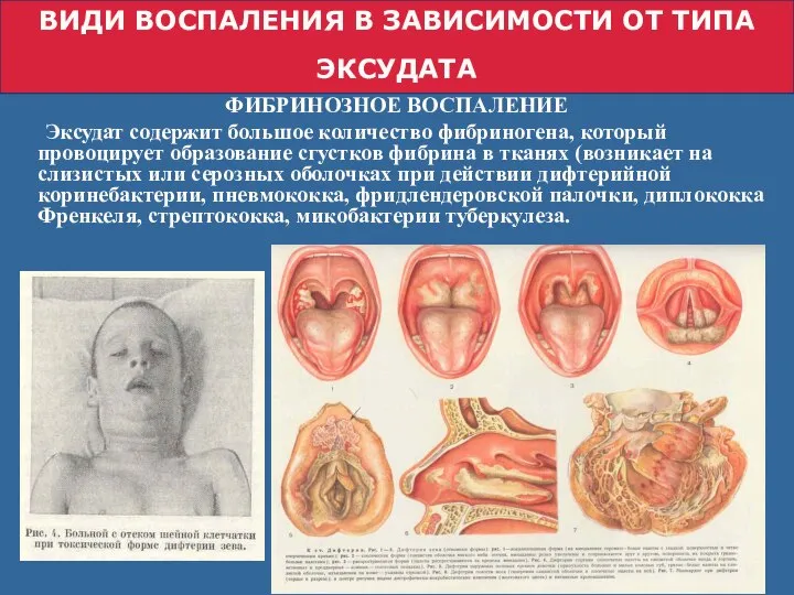 ВИДИ ЗАПАЛЕННЯ ЗА ТИПОМ ЕКСУДАТУ ФИБРИНОЗНОЕ ВОСПАЛЕНИЕ Эксудат содержит большое количество