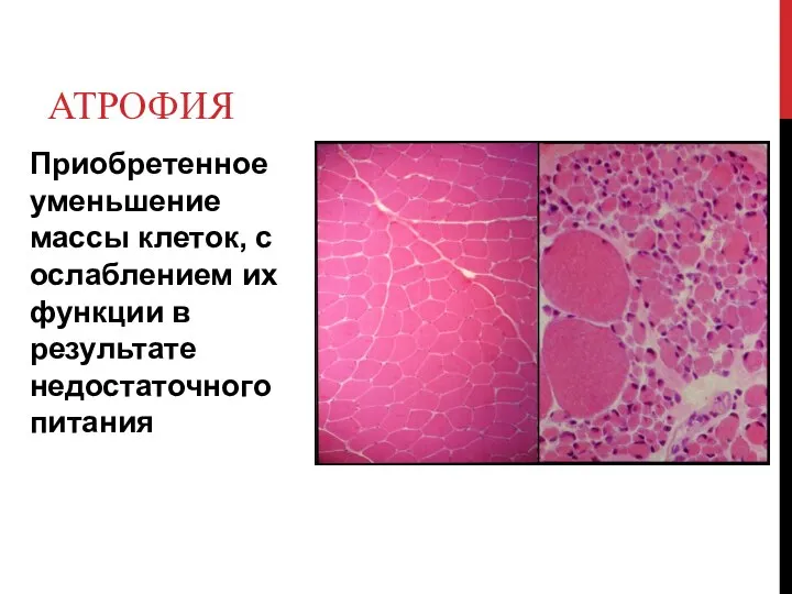 АТРОФИЯ Приобретенное уменьшение массы клеток, с ослаблением их функции в результате недостаточного питания