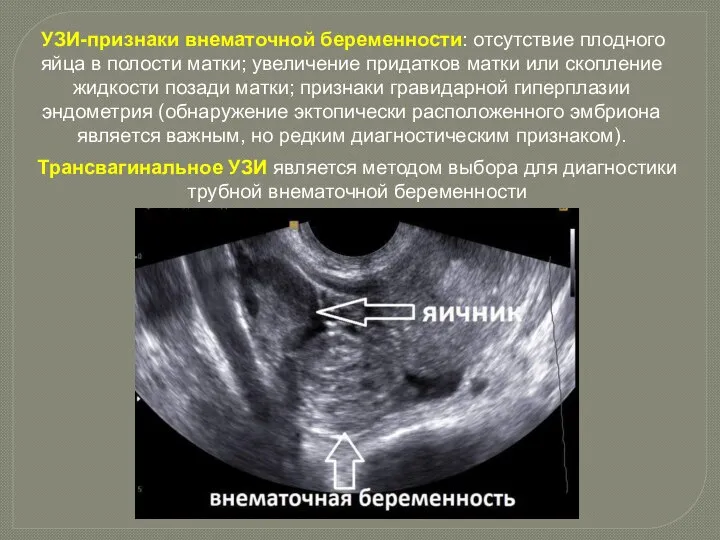 УЗИ-признаки внематочной беременности: отсутствие плодного яйца в полости матки; увеличение придатков