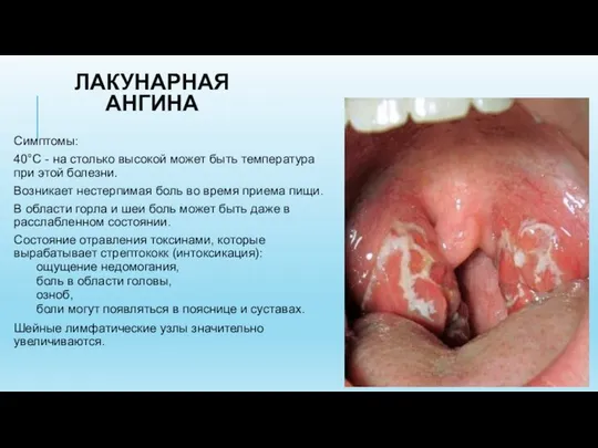ЛАКУНАРНАЯ АНГИНА Симптомы: 40°С - на столько высокой может быть температура