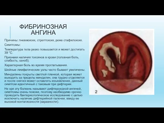 ФИБРИНОЗНАЯ АНГИНА Причины: пневмококк, стрептококк, реже стафилококк. Симптомы: Температура тела резко