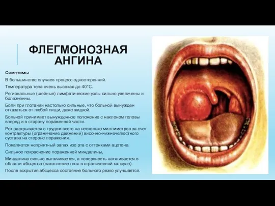 ФЛЕГМОНОЗНАЯ АНГИНА Симптомы В большинстве случаев процесс односторонний. Температура тела очень