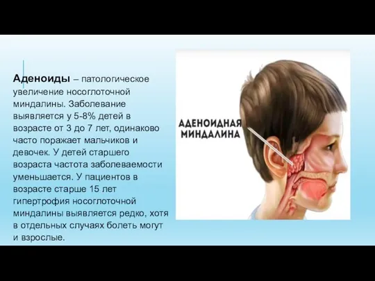 Аденоиды – патологическое увеличение носоглоточной миндалины. Заболевание выявляется у 5-8% детей