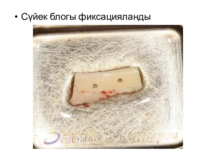 Сүйек блогы фиксацияланды