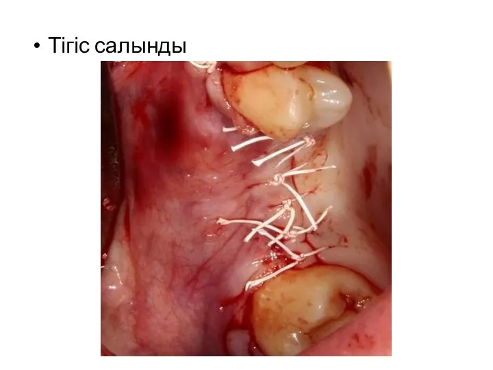 Тігіс салынды