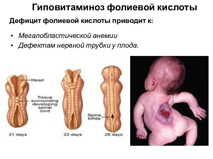 Мегалобластической анемии Дефектам нервной трубки у плода. Дефицит фолиевой кислоты приводит к: Гиповитаминоз фолиевой кислоты