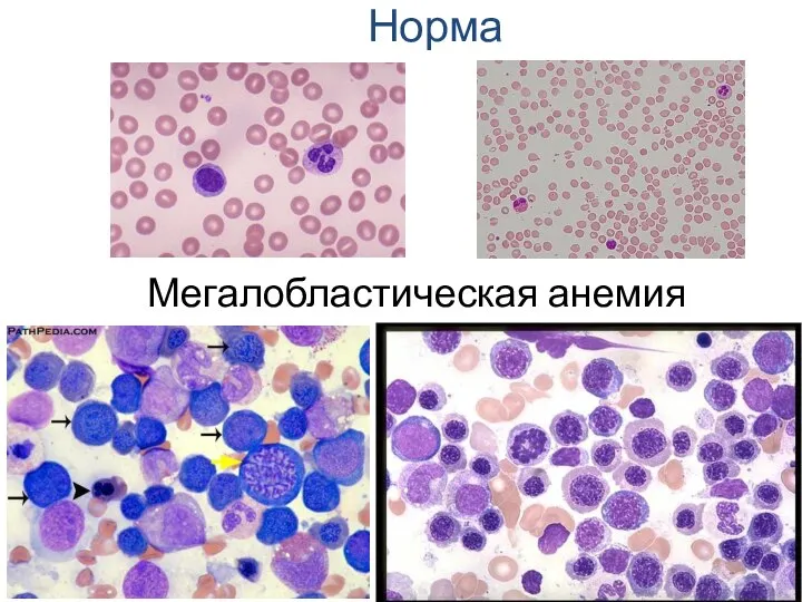 Мегалобластическая анемия Норма