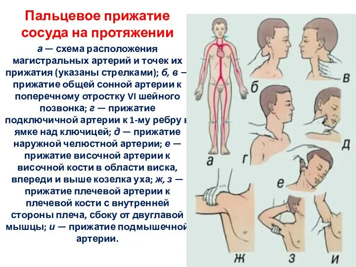 Пальцевое прижатие сосуда на протяжении а — схема расположения магистральных артерий