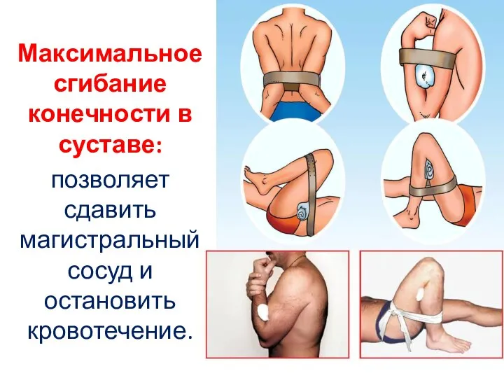 Максимальное сгибание конечности в суставе: позволяет сдавить магистральный сосуд и остановить кровотечение.