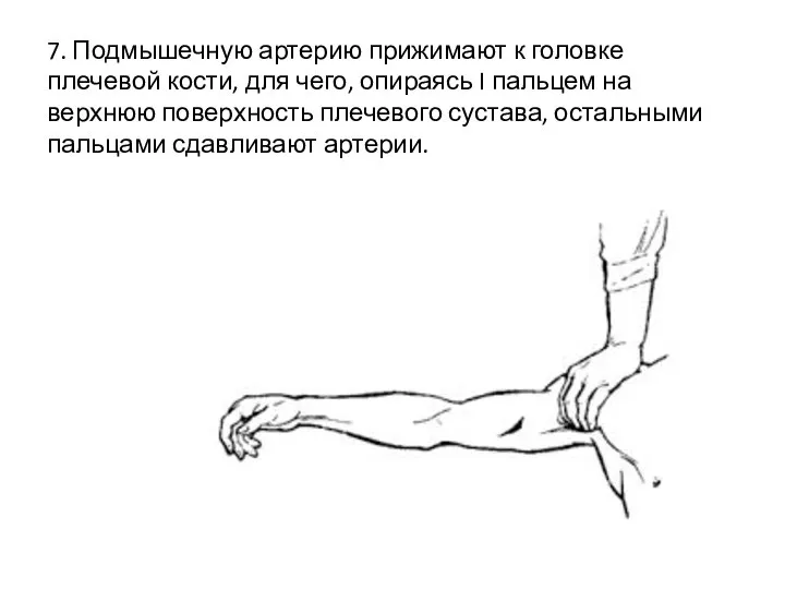 7. Подмышечную артерию прижимают к головке плечевой кости, для чего, опираясь